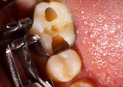 The aesthetic restoration of a lower molar tooth with composite resin.